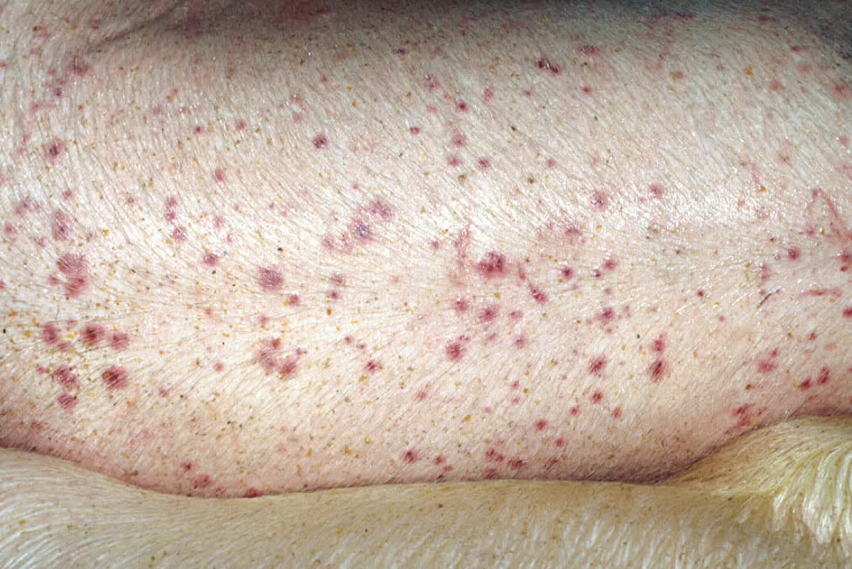 Mosquito Bites on Swine